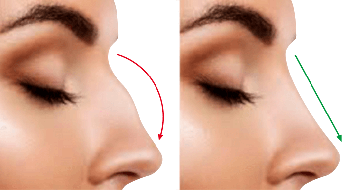 La ciudad de Cuenca como Epicentro de Tendencias en Rinoplastia: