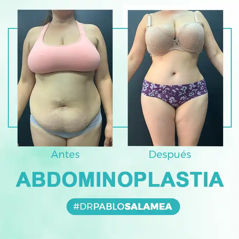 Abdominoplastia en Cuenca