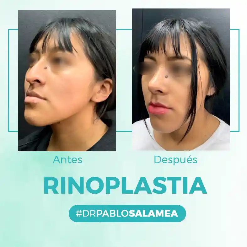 Rinoplastia_Dr_Pablo_Salamea