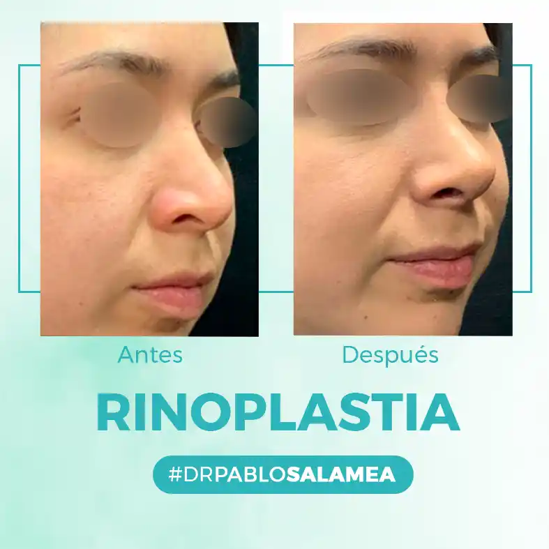 Rinoplastia_Dr_Pablo_Salamea