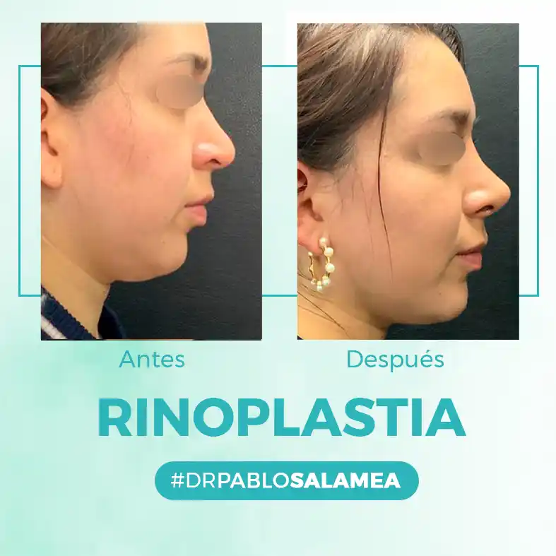 Rinoplastia_Dr_Pablo_Salamea