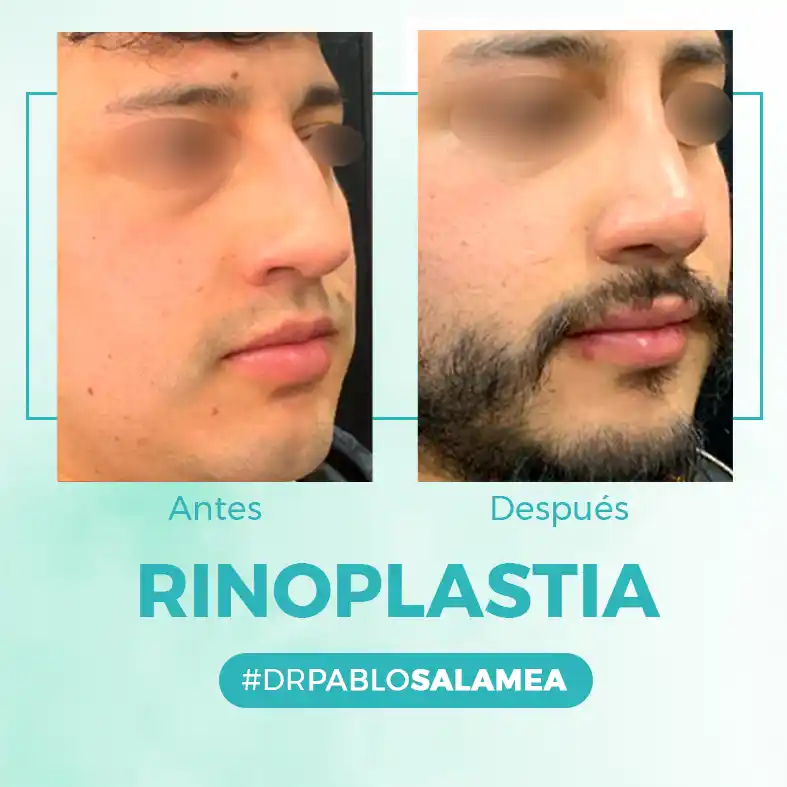 Rinoplastia_Dr_Pablo_Salamea