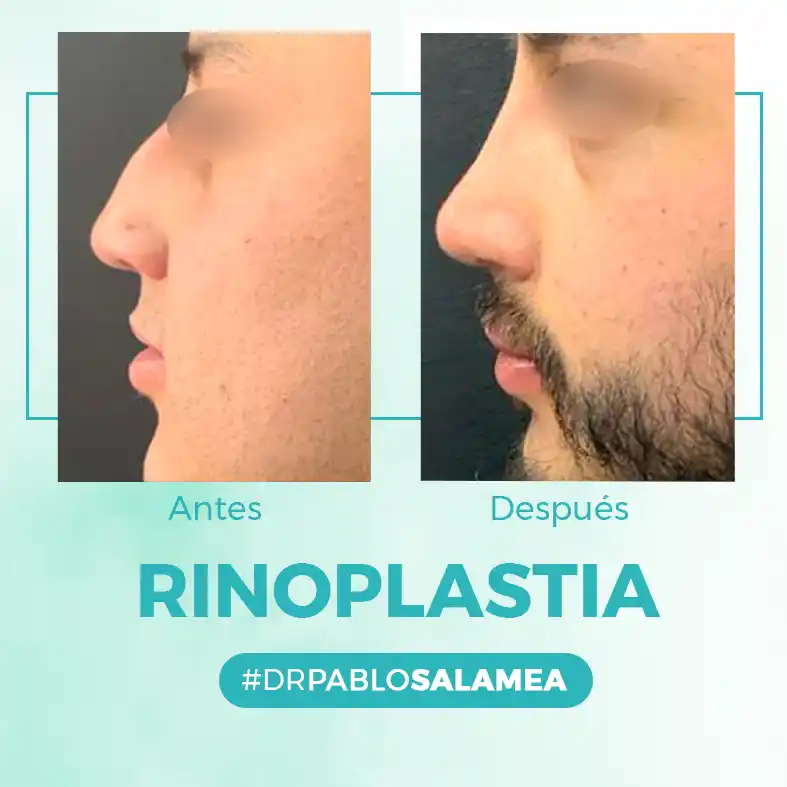 Rinoplastia_Dr_Pablo_Salamea