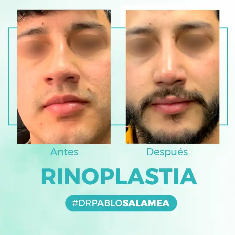 Rinoplastia_Dr_Pablo_Salamea