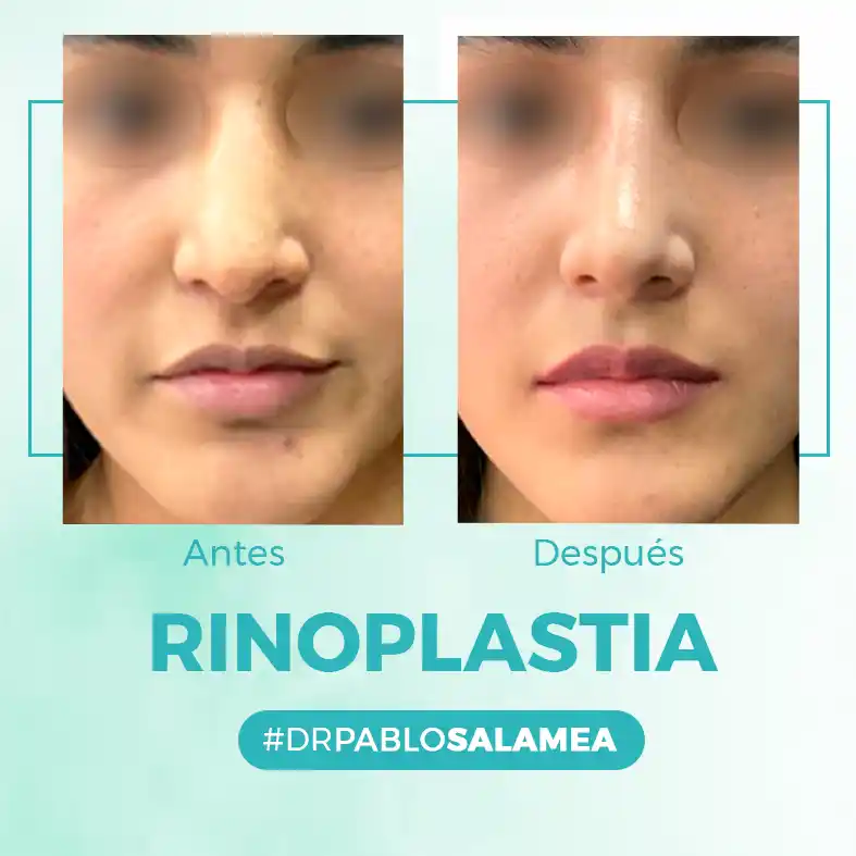 Rinoplastia_Dr_Pablo_Salamea