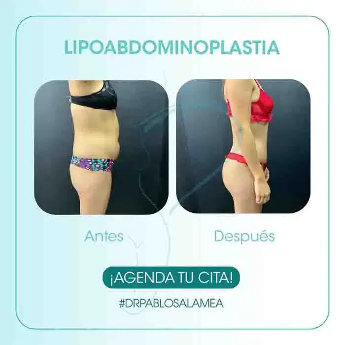 lipoabdominoplastía en Cuenca
