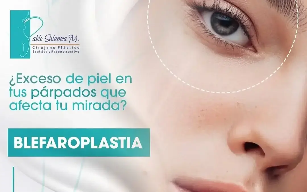 Blefaroplastia con el Dr. Pablo Salamea: Rejuvenece Tu Mirada en Cuenca