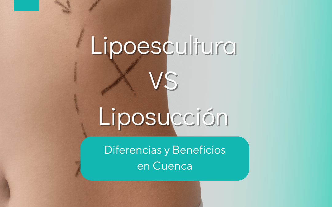 Lipoescultura vs. Liposucción: Diferencias y Beneficios en Cuenca