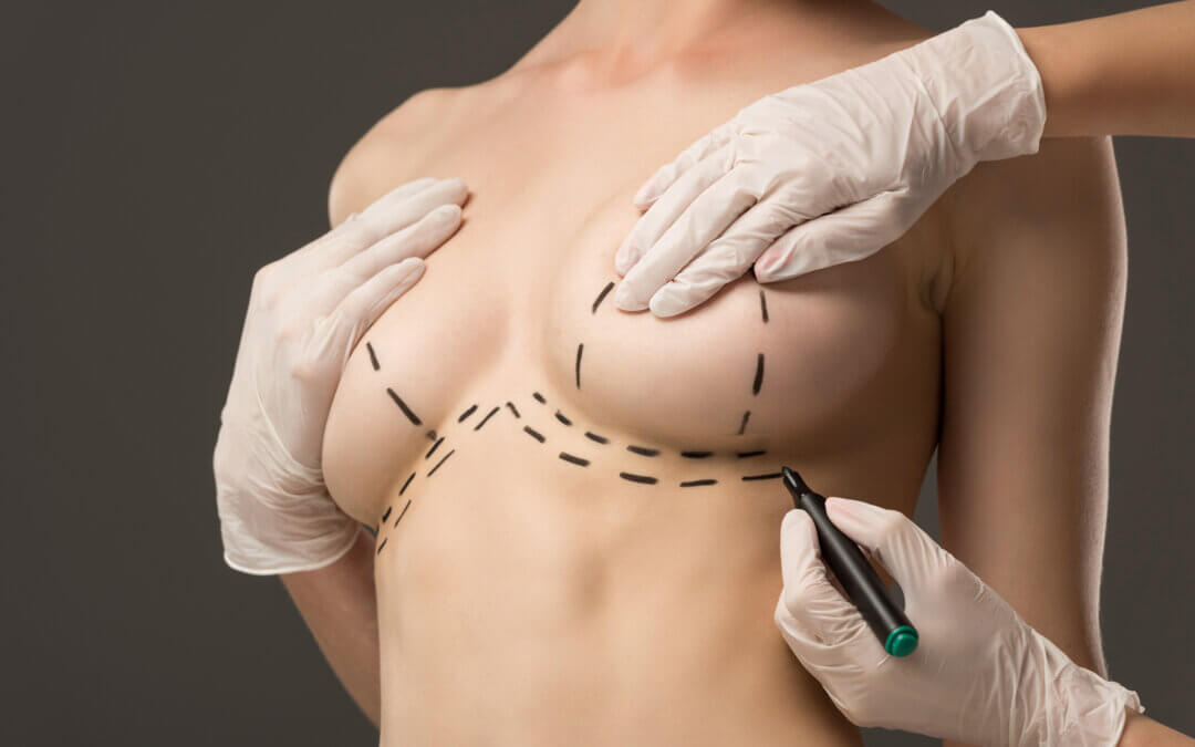 Aumento de Senos en Cuenca: Belleza y Seguridad