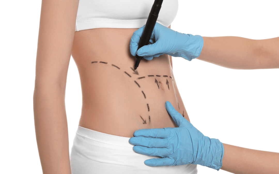 Liposucción vs Abdominoplastia | Diferencias