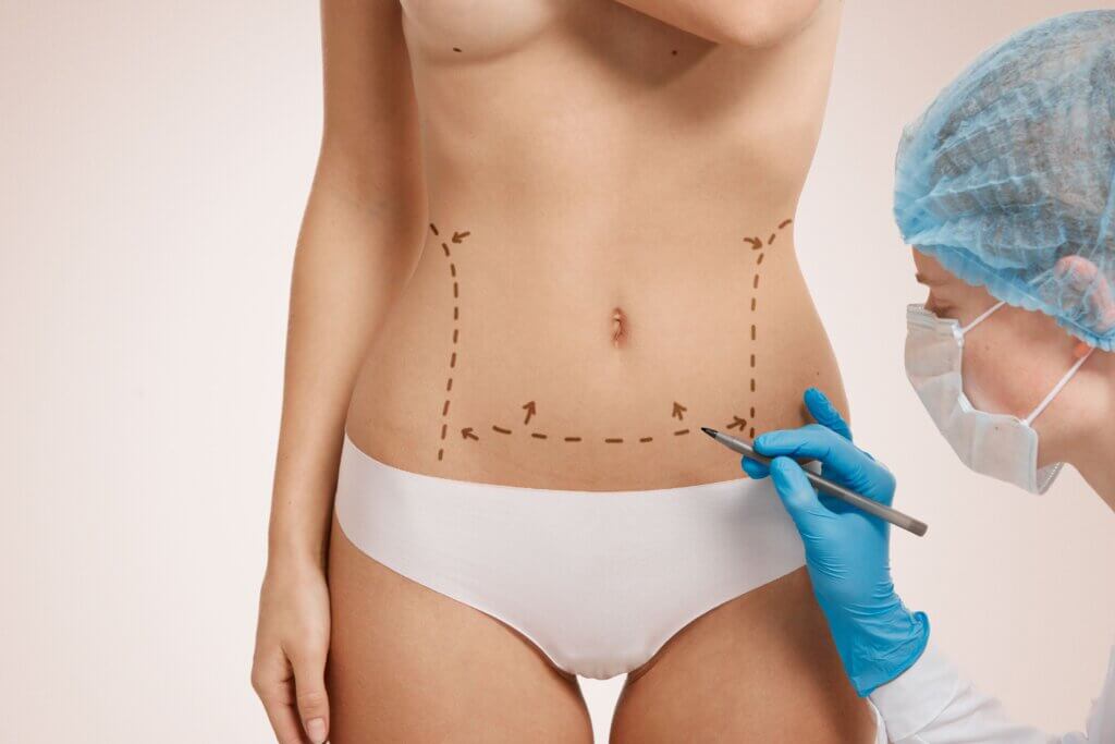 Liposucción de Alta Definición: Esculpe tu figura en Ecuador