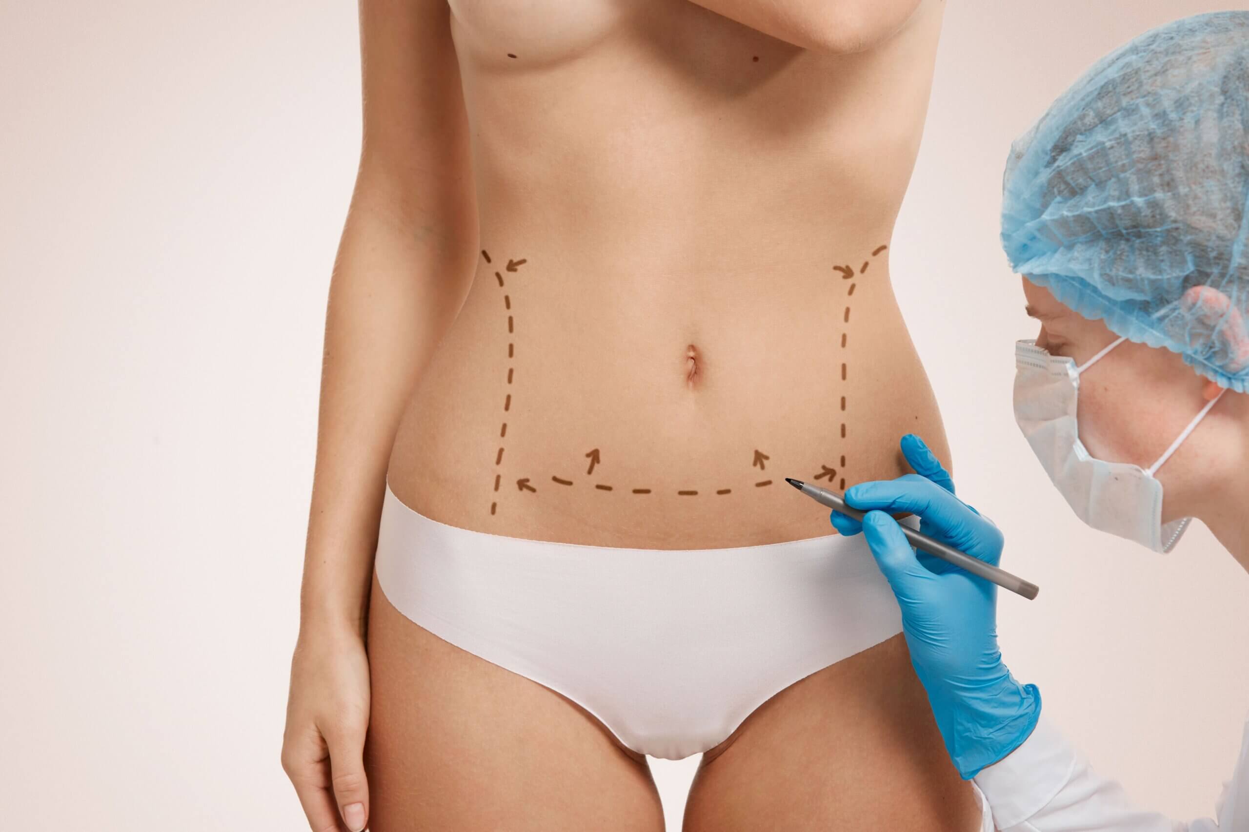 Liposucción de Alta Definición: Esculpe tu figura en Ecuador